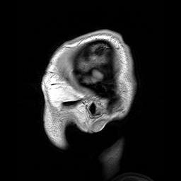 Chụp MRI đầu con người ở bệnh nhân bị tật đầu nhỏ gia đình lành tính trước chấn thương não (ANIMATED) .gif