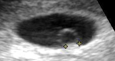 Ultrasonido del embrión a las 5 semanas.png