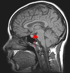 Hypothalamus.jpg