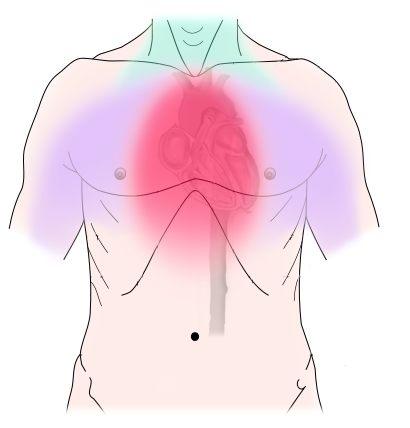 Pulmoner yüksek tansiyon - Vikipedi