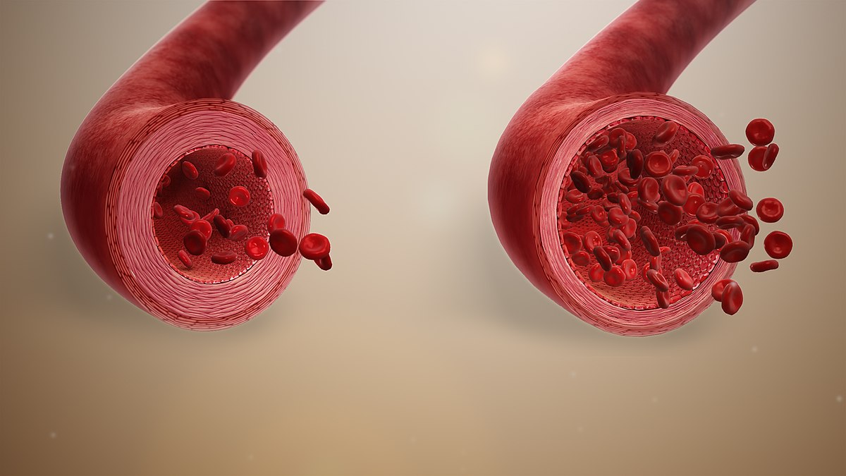 kan viskozitesi hipertansiyonu