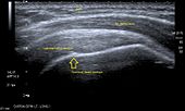 Longitudinal ultra sonography of the supraspinatus tendon