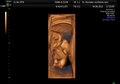 File:Fetal movements 3D Ultrasound Dr. Wolfgang Moroder.theora.ogv
