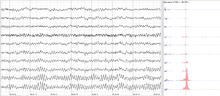 Human EEG with prominent alpha-rhythm