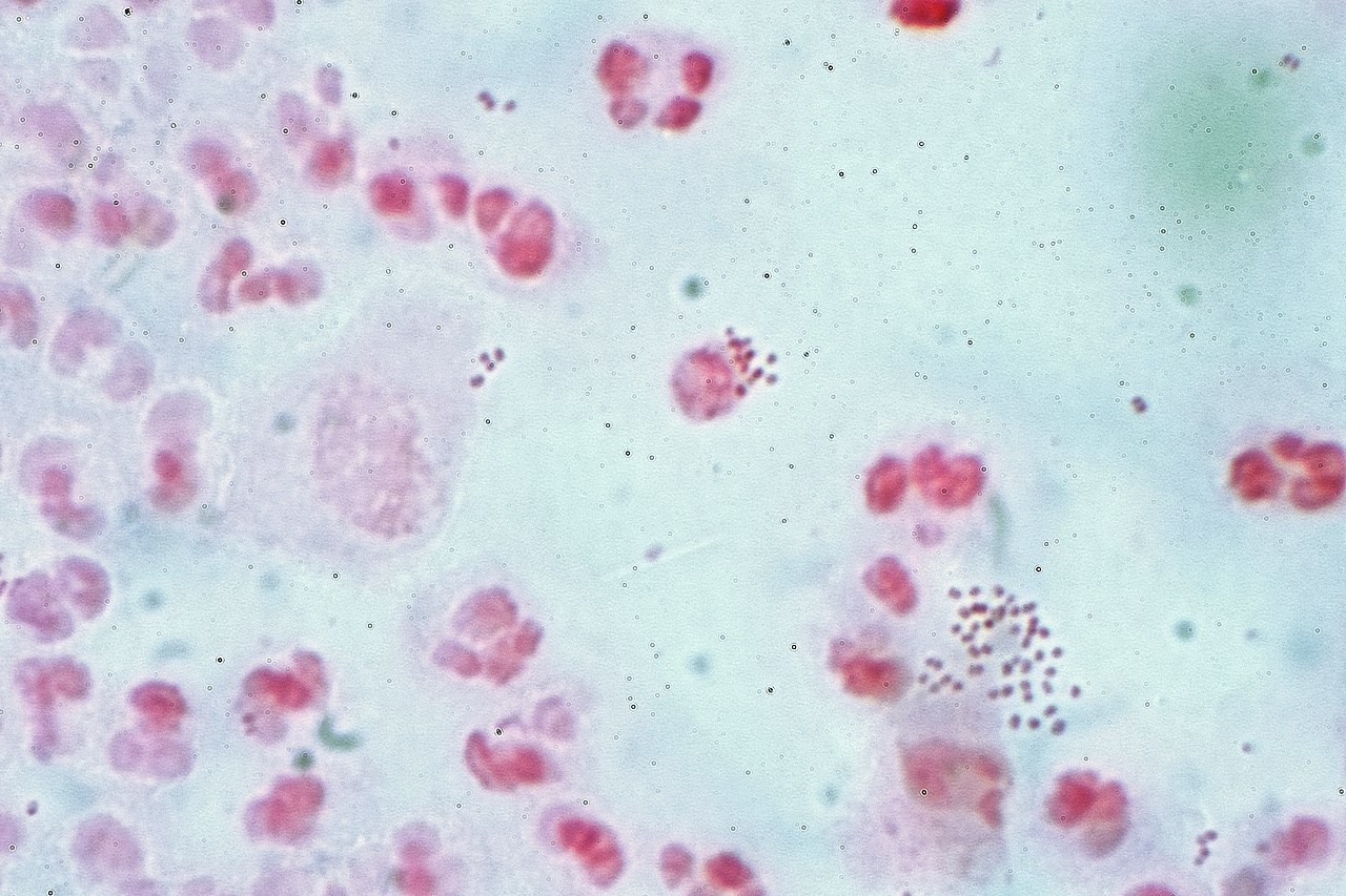 fecal enterococcus és prostatitis)