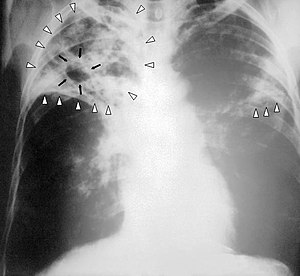 วัณโรค x-ray-1.jpg