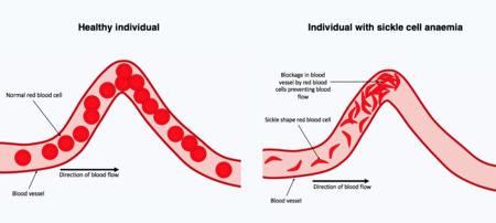 two blood curved vessels are shown, on the left one blood vessel contain normal red blood cells throughout the vessel. On the right, the red blood cells have a dish shape due to being sickled, a blockage composed of these distorted red blood cells is present at the curve in the blood vessel.