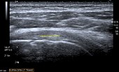 Transversal ultra sonography of the supraspinatus tendon