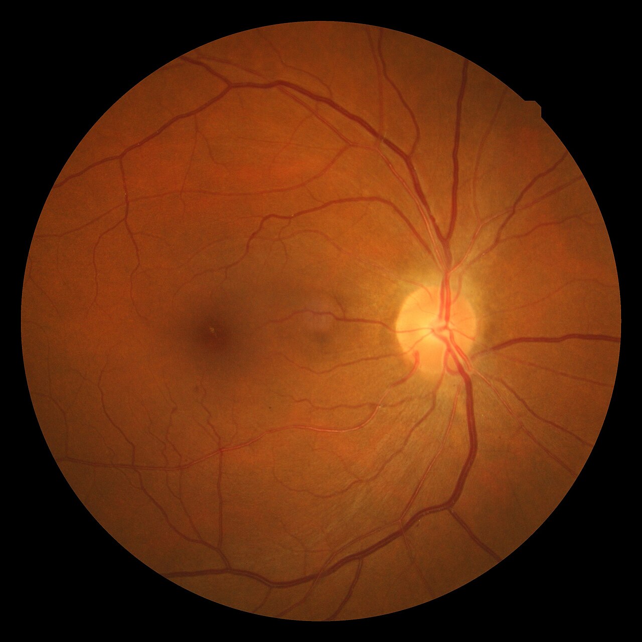 hipertansiyonlu retinopati